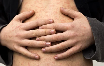 Autoimmune Disease treatment at Republic Pain & Longevity