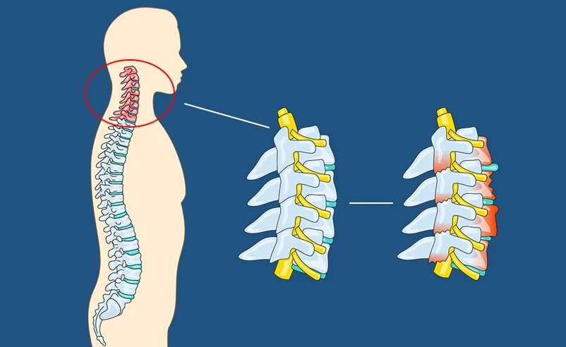 Neck Pain treatment in Bryan, TX