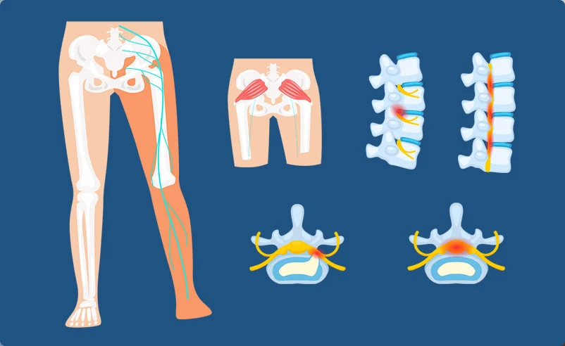 Piriformis Syndrome treatment in Bryan, TX