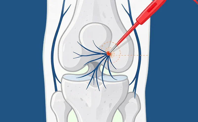 Genicular Nerve Block & Radiofrequency Ablation (RFA) at Republic Pain & Longevity in Bryan, TX